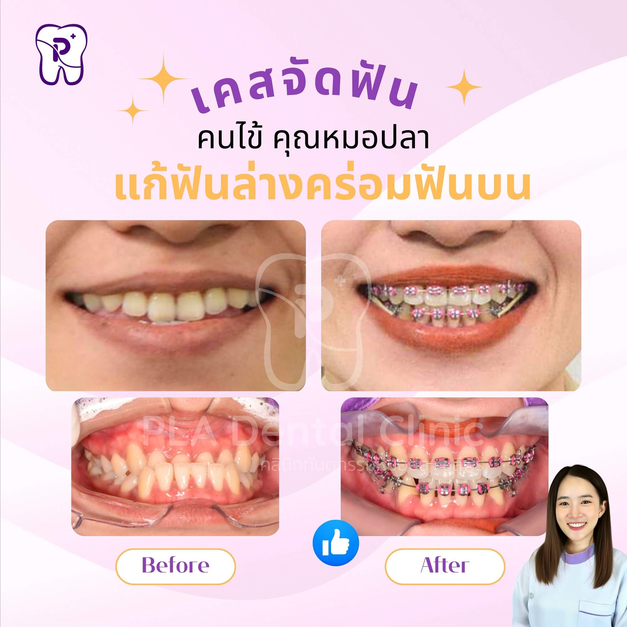 แก้ฟันล่างคร่อมฟันบน