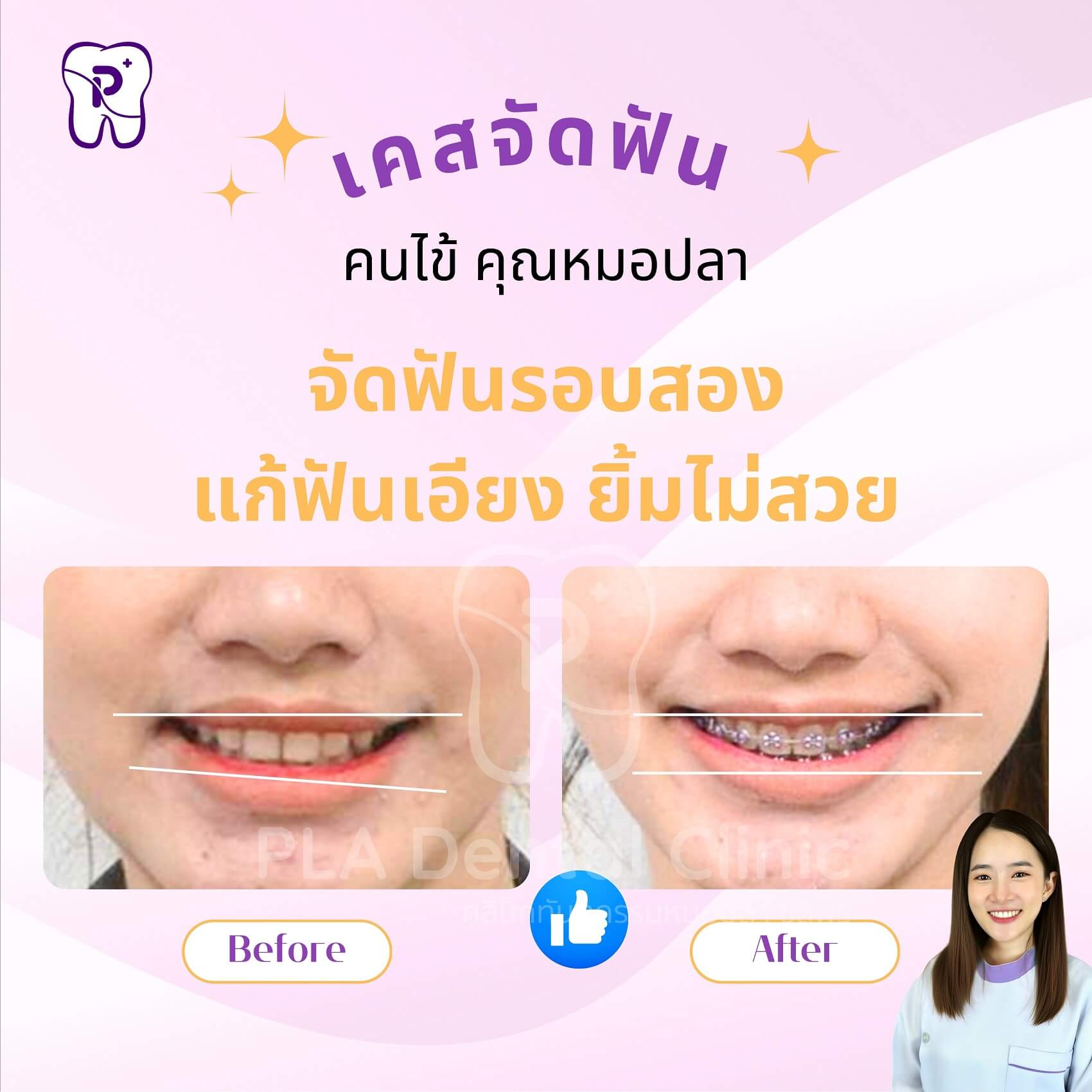 จัดฟันรอบสอง แก้ฟันเอียง ยิ้มไม่สวย