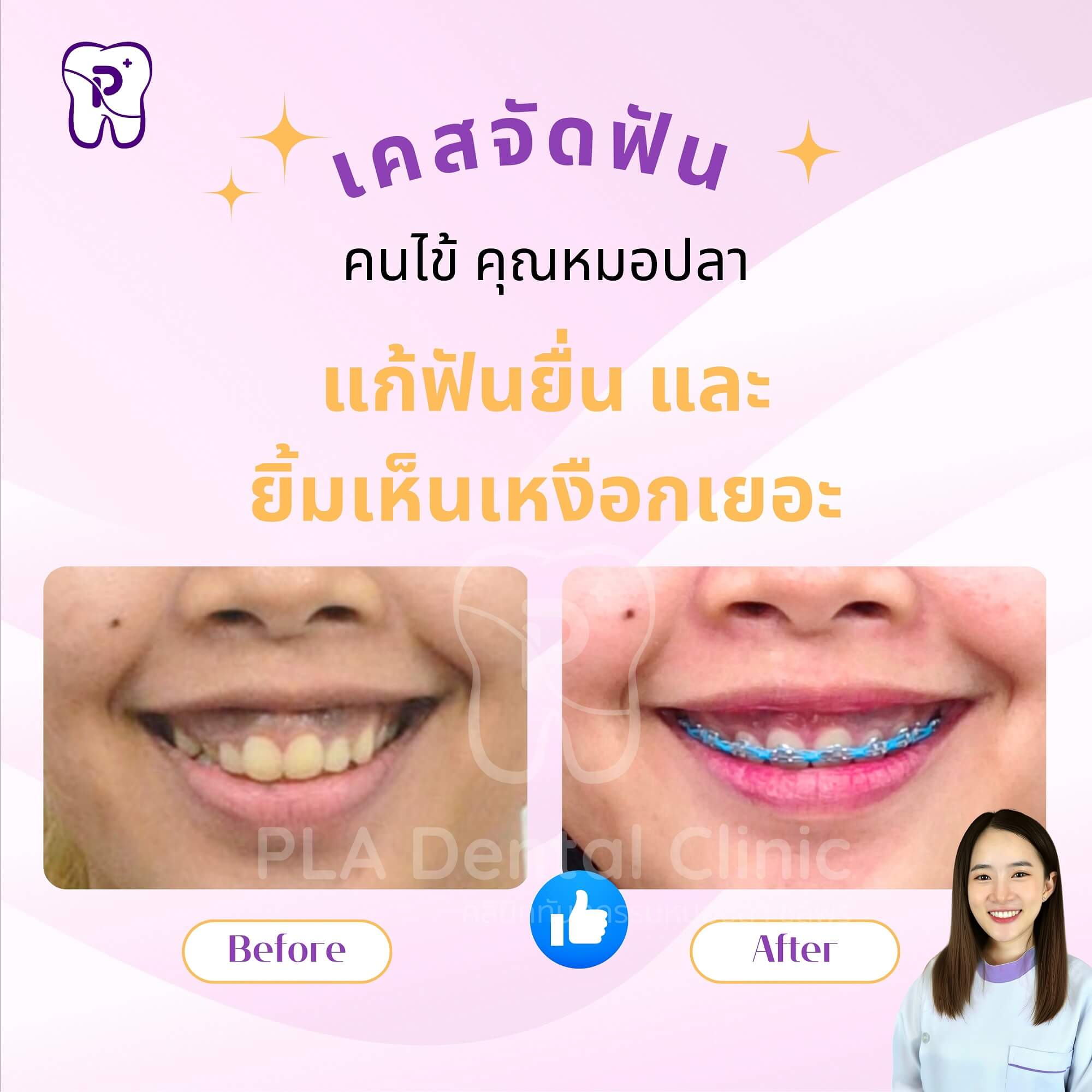 แก้ฟันยื่น และ ยิ้มเห็นเหงือกเยอะ