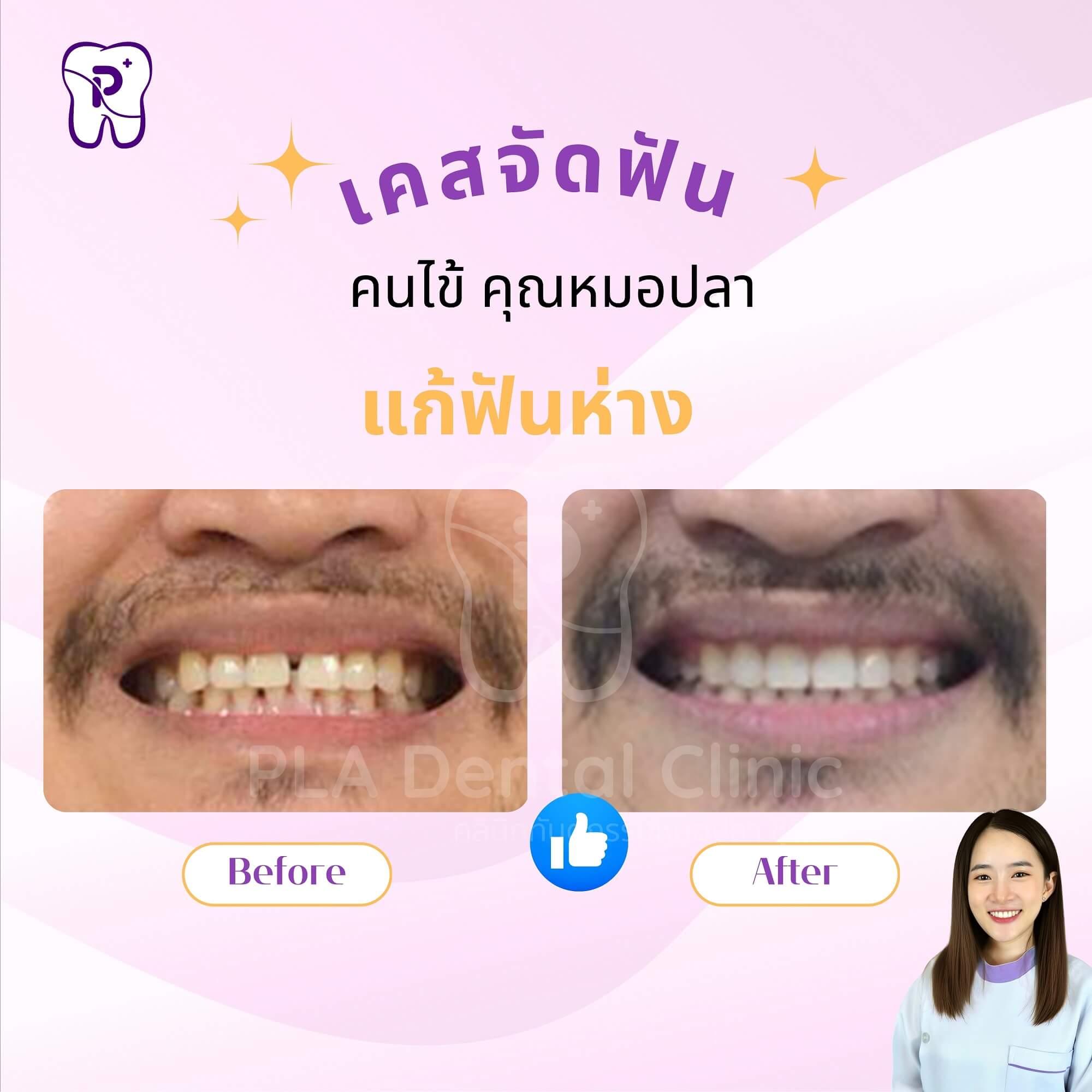 แก้ฟันห่าง