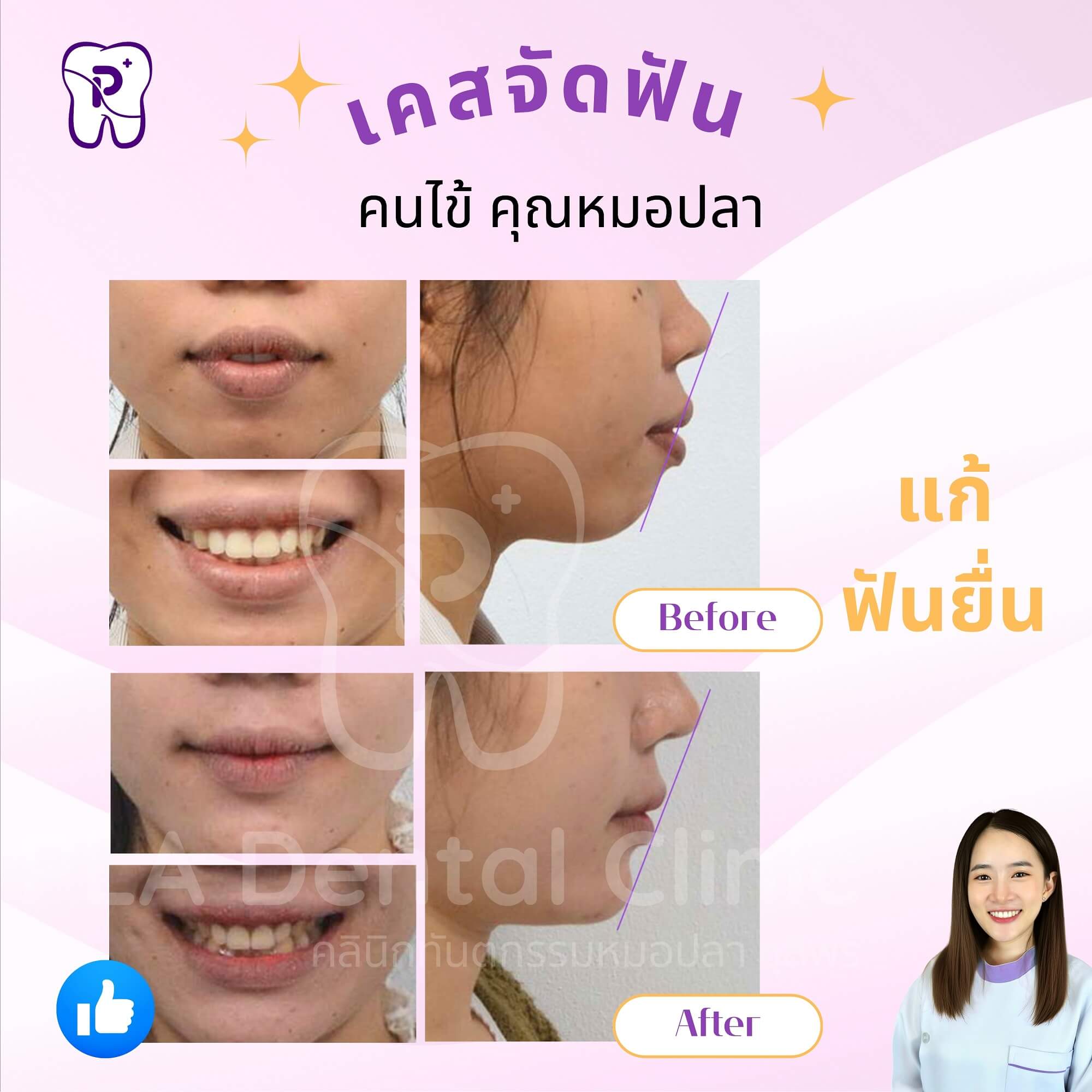 แก้ฟันยื่น