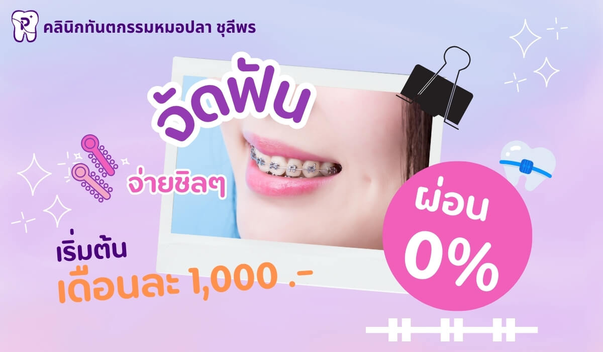 โปรจัดฟันแบบสบายกระเป๋า ผ่อน 0% เริ่ม 1000 บาทต่อเดือน